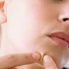 【顎ニキビを解決】悩みの顎ニキビを治して憧れのつるつる素肌になろう！原因や対策を徹底解説