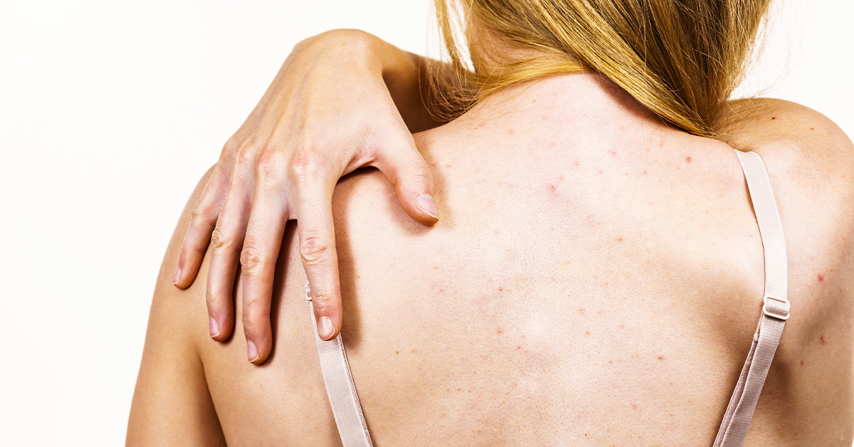 背中ニキビの原因と治し方は？やりがちなNG行動や効果的なケアを知って背中美人に♡