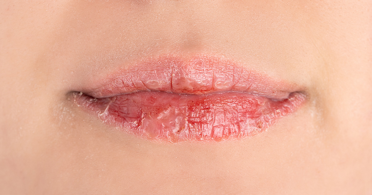 唇のふちがヒリヒリする原因と対処法は？ヘルペスの可能性や唇ケアにおすすめな薬用リップも紹介