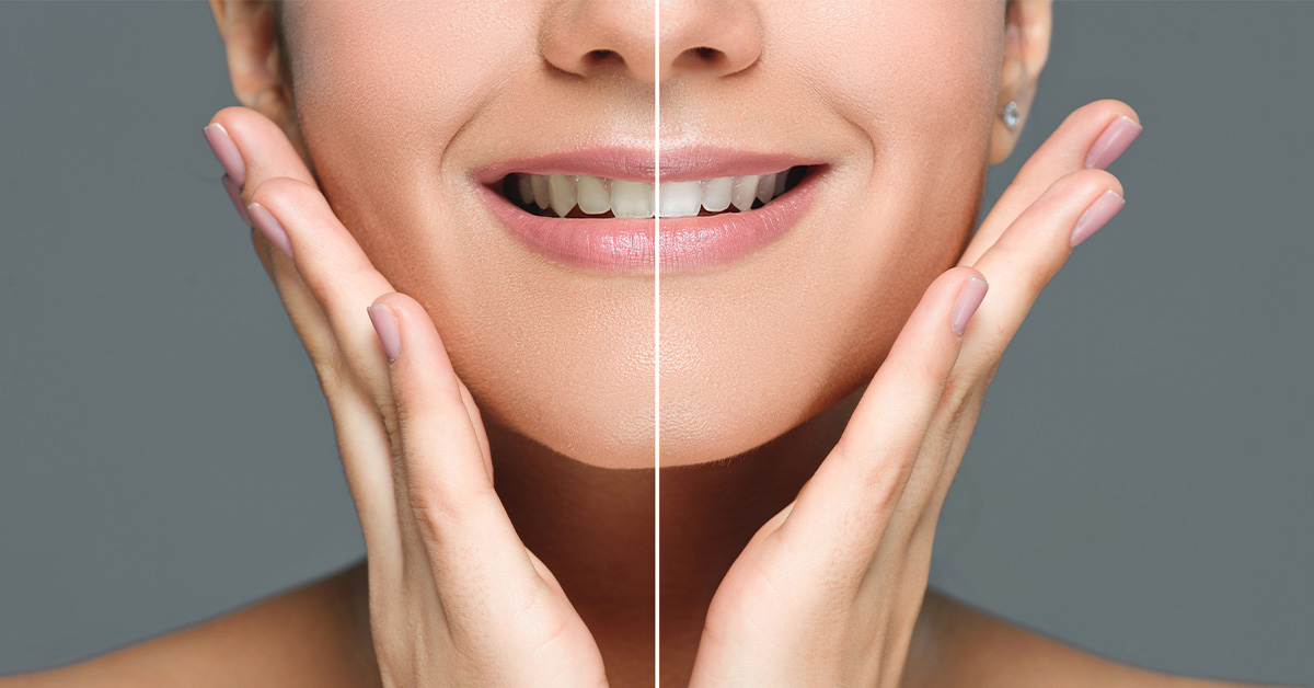 ホワイトニングで後悔するってホント？よくある失敗や回避する方法を知って明るく白い歯に