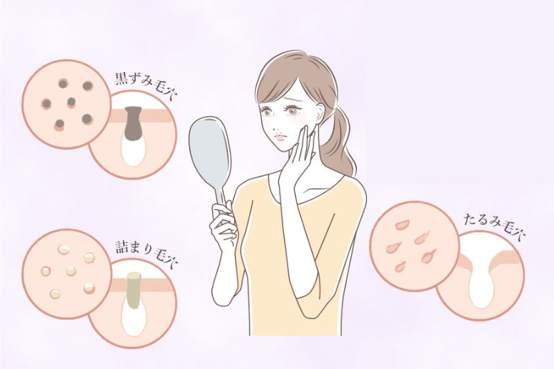 毛穴の種類紹介