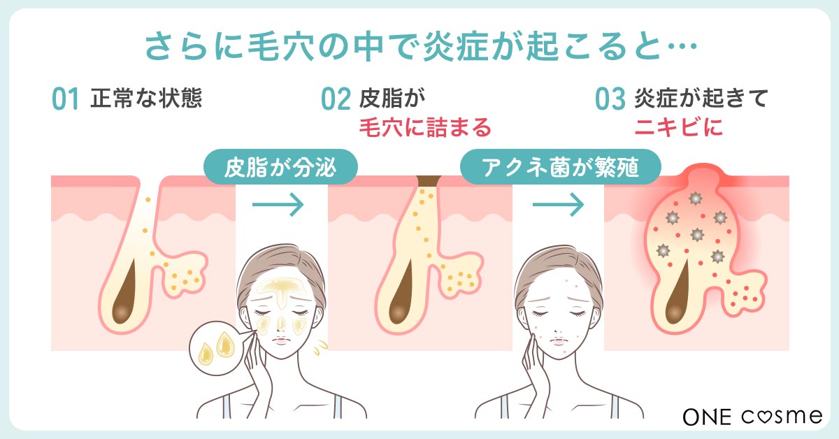 鼻の脂が引き起こす肌荒れやニキビ