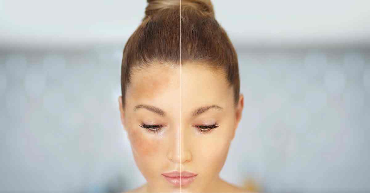 シミができやすい人の特徴