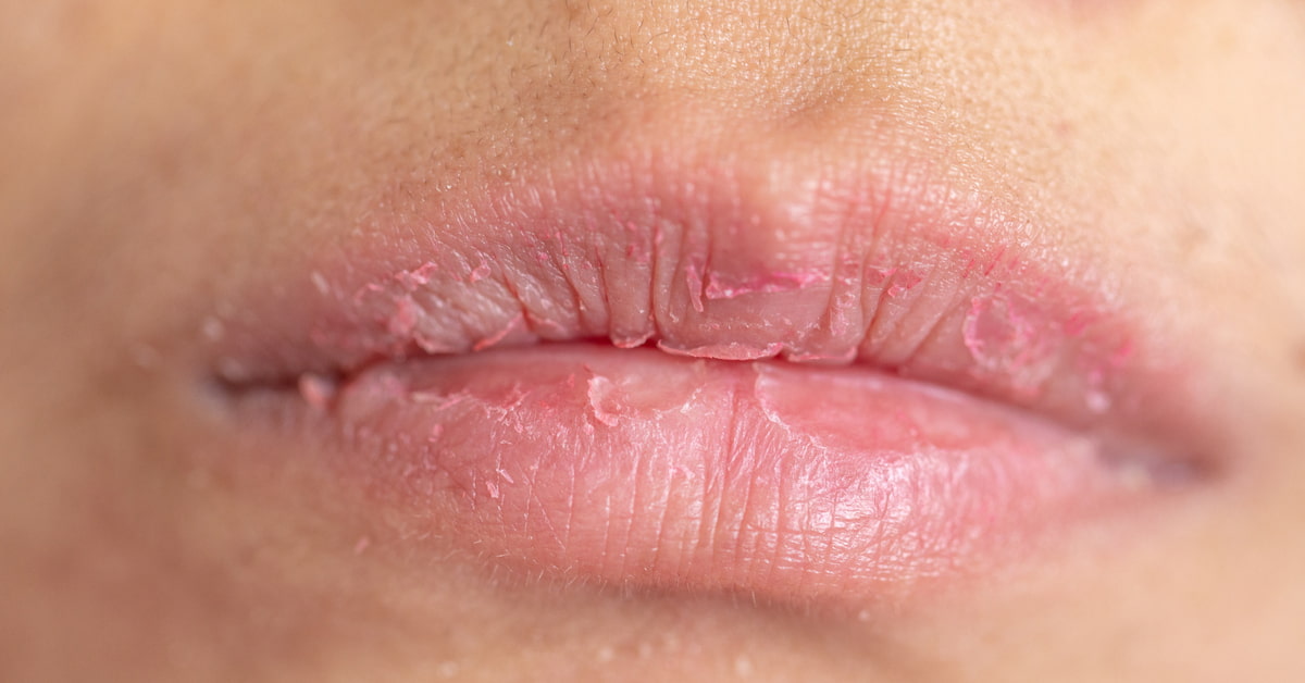 唇が荒れやすい行動とは?唇を舐める、強くこするなどの癖があると荒れやすくなる