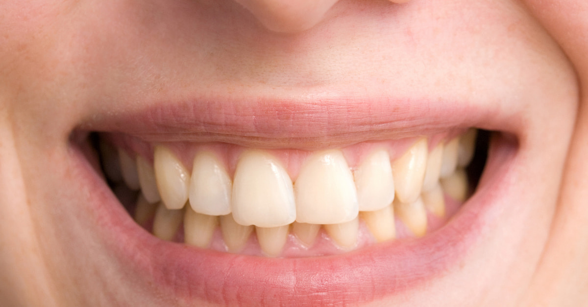 生まれつきで歯の黄ばみがあるのはどうして?歯の内側の色のほか、先天性の病気による可能性あり