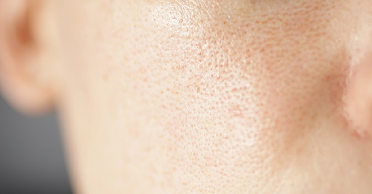 あなたの顔の毛穴トラブルはどれ?種類ごとの原因を知って毛穴レス肌へ導こう