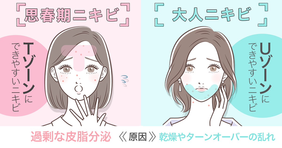 思春期ニキビ・大人ニキビ