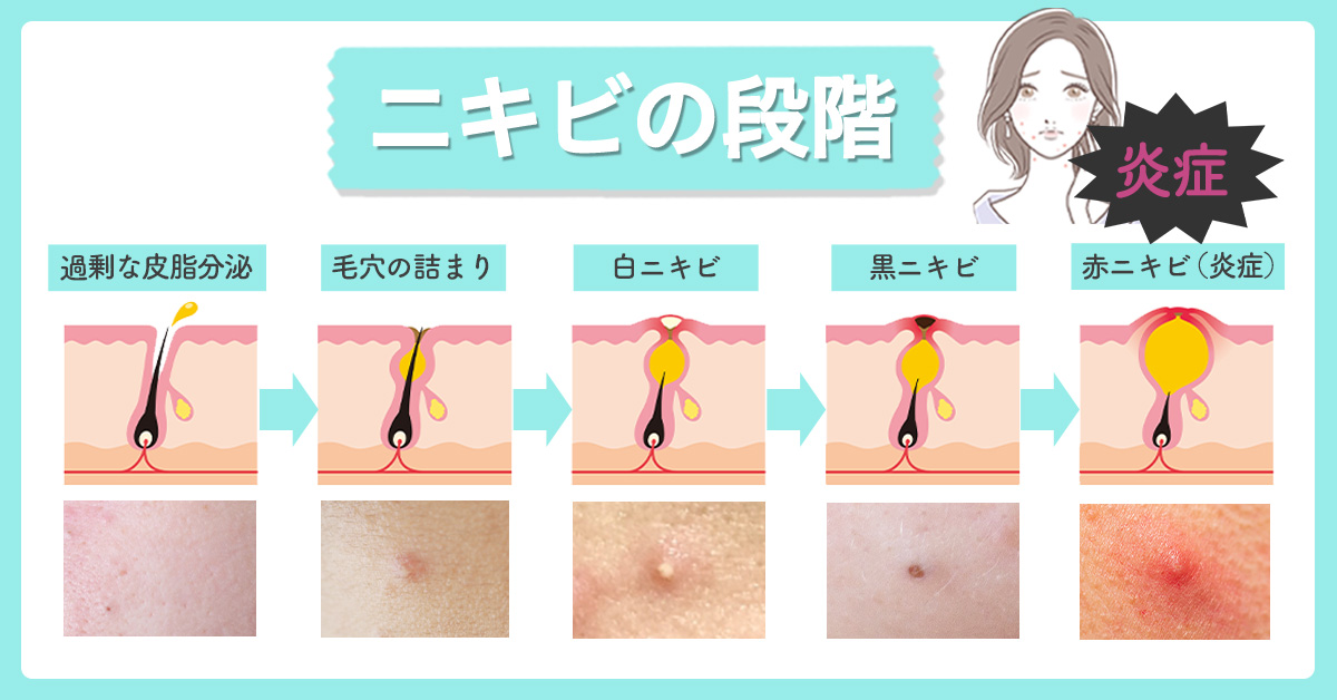 ニキビの段階