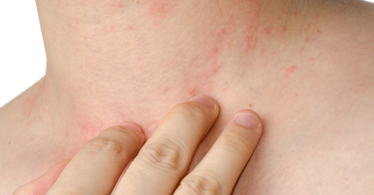 アトピーの肌が黒い原因は?薬ではなく物理的な刺激のせいかも…