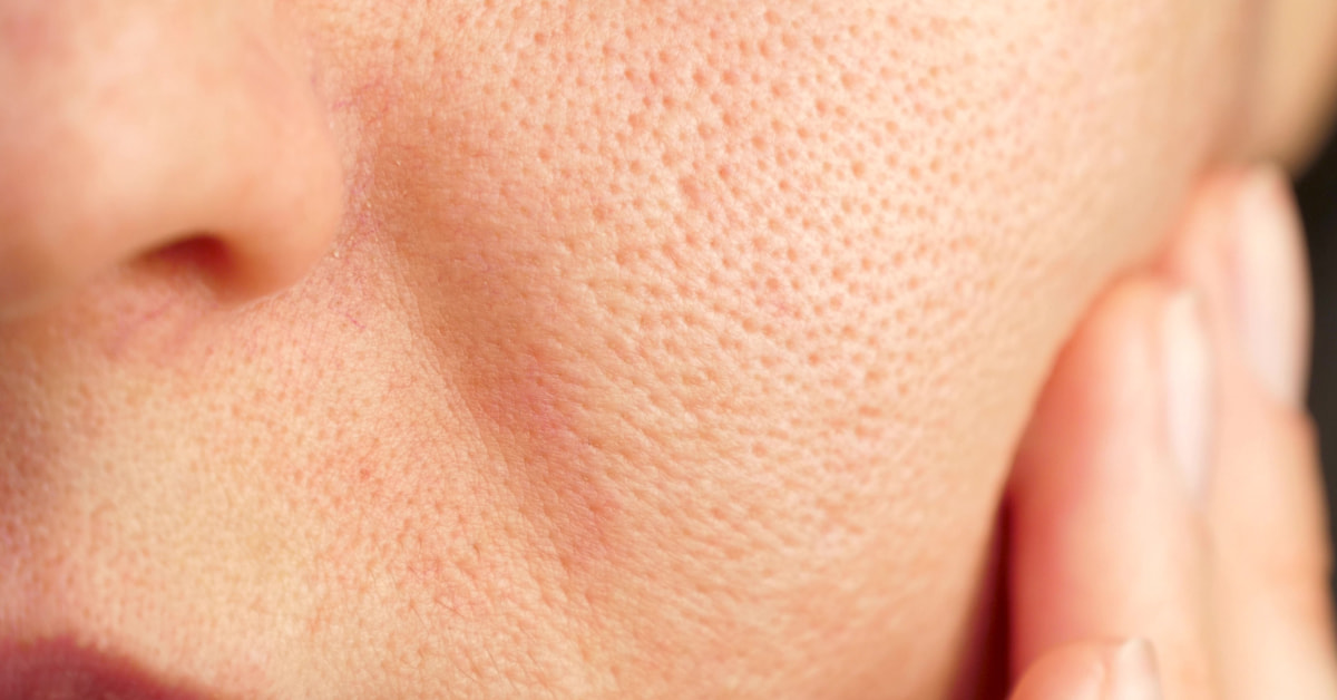 【アラサーの毛穴トラブルについて】症状や原因をチェックして正しいケアに導こう