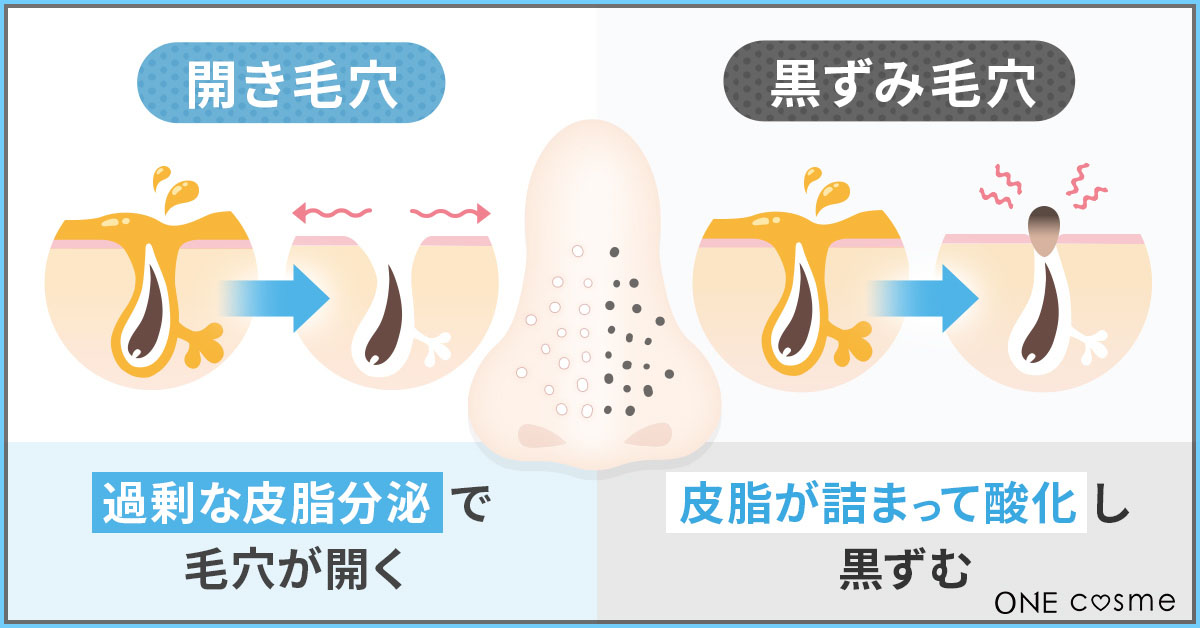 開き毛穴と黒ずみ毛穴の原因