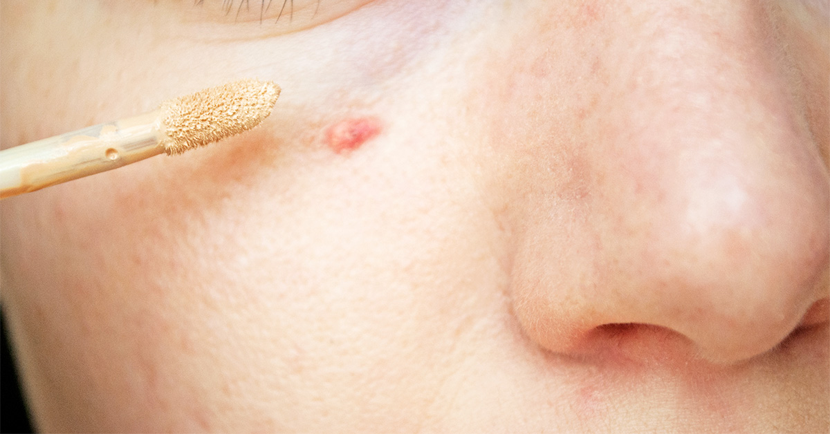 【2025最強】ニキビコンシーラーおすすめランキング10選！プチプラ・メンズ・薬用タイプまで発表